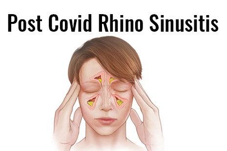 Post Covid Rhino Sinusitis 